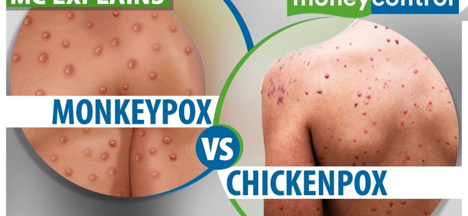 Does the chickenpox vaccination protect against monkey pox? [WE EXPLAIN]