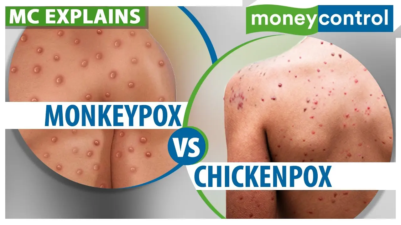 Does the chickenpox vaccination protect against monkey pox? [WE EXPLAIN]