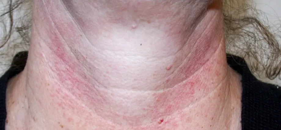 Does your neck look like this? This could be an illness