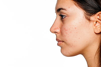 Does your teen have acne? Find out how to help him