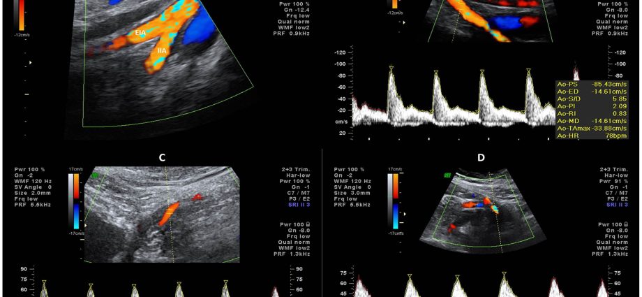 Doppler examination &#8211; indications, course, examination in pregnancy