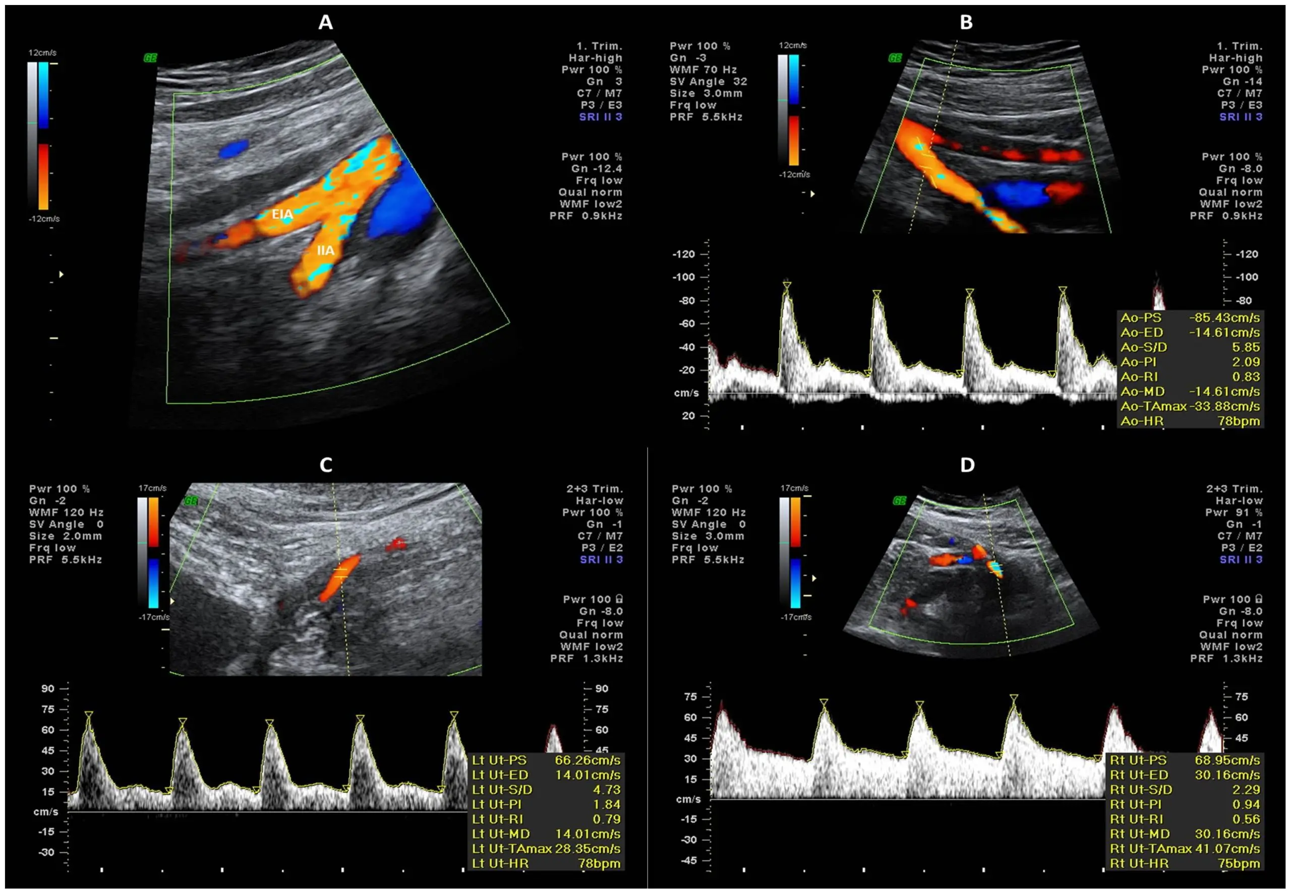 Doppler examination &#8211; indications, course, examination in pregnancy