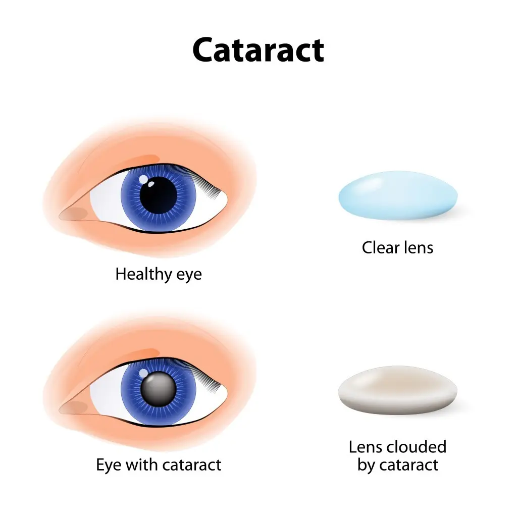 Double vision &#8211; causes, treatment