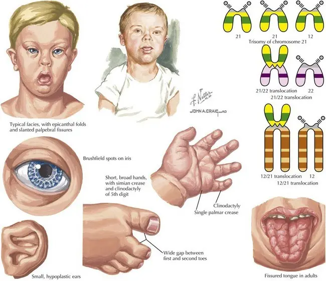 Down syndrome (trisomy 21) &#8211; causes, symptoms