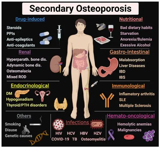 Drug-induced osteoporosis, i.e. the side effects of taking steroids