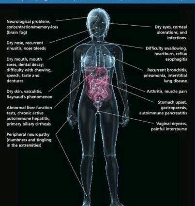 Dry mouth &#8211; the most common causes, home remedies, Sjogren&#8217;s syndrome