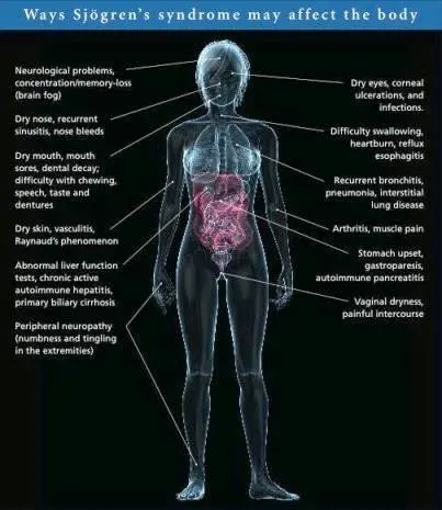 Dry mouth &#8211; the most common causes, home remedies, Sjogren&#8217;s syndrome