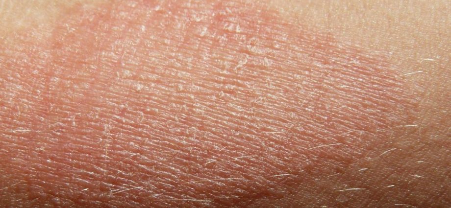 Dry skin &#8211; causes, types and methods of care