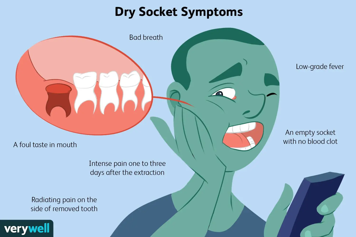 Dry socket &#8211; causes, symptoms, treatment. How to avoid a dry socket?