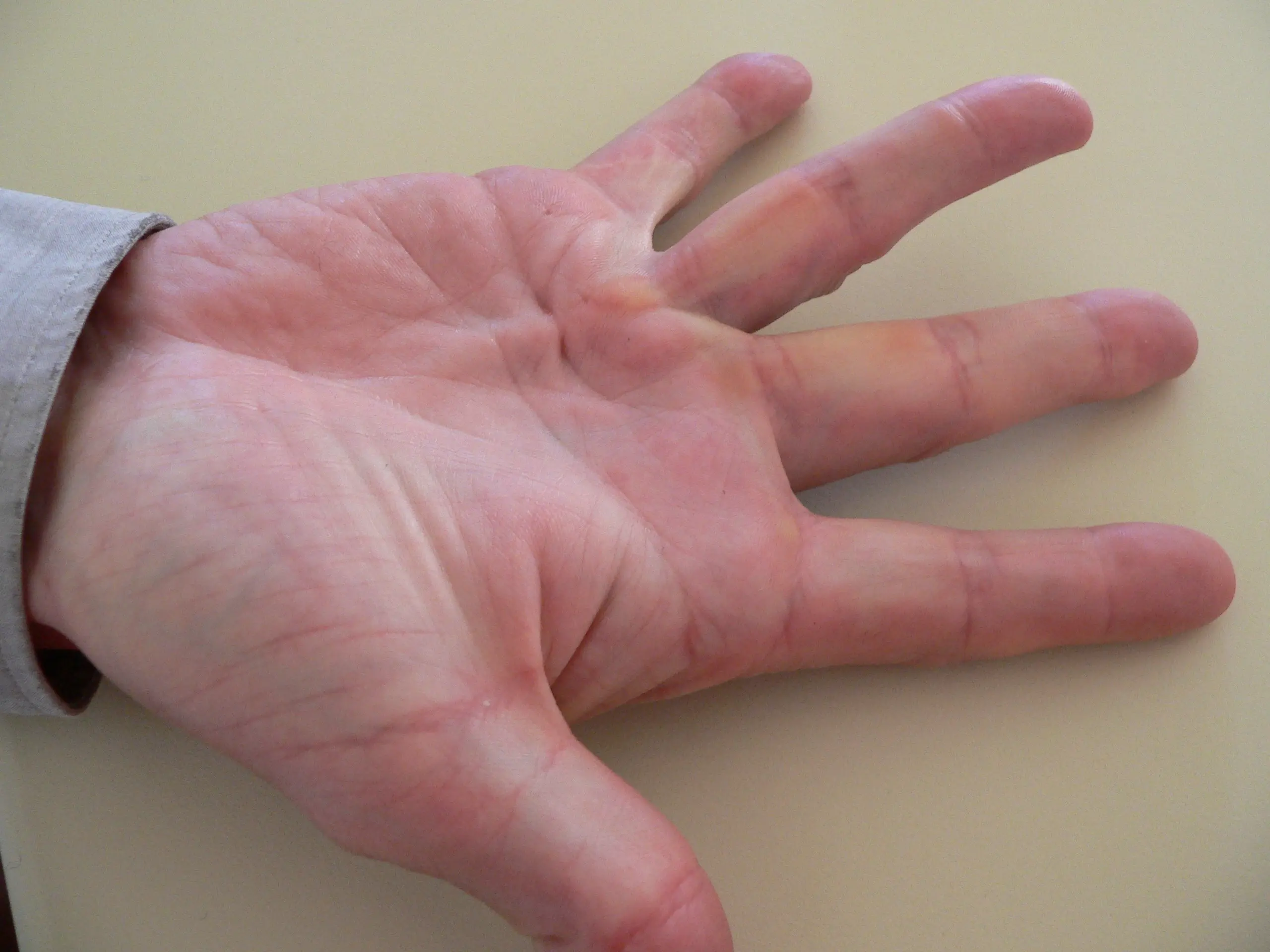 Dupuytren&#8217;s contracture &#8211; symptoms, causes, surgery, treatment