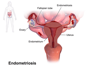 During her menstrual period, she coughed up blood &#8211; an unusual case of endometriosis