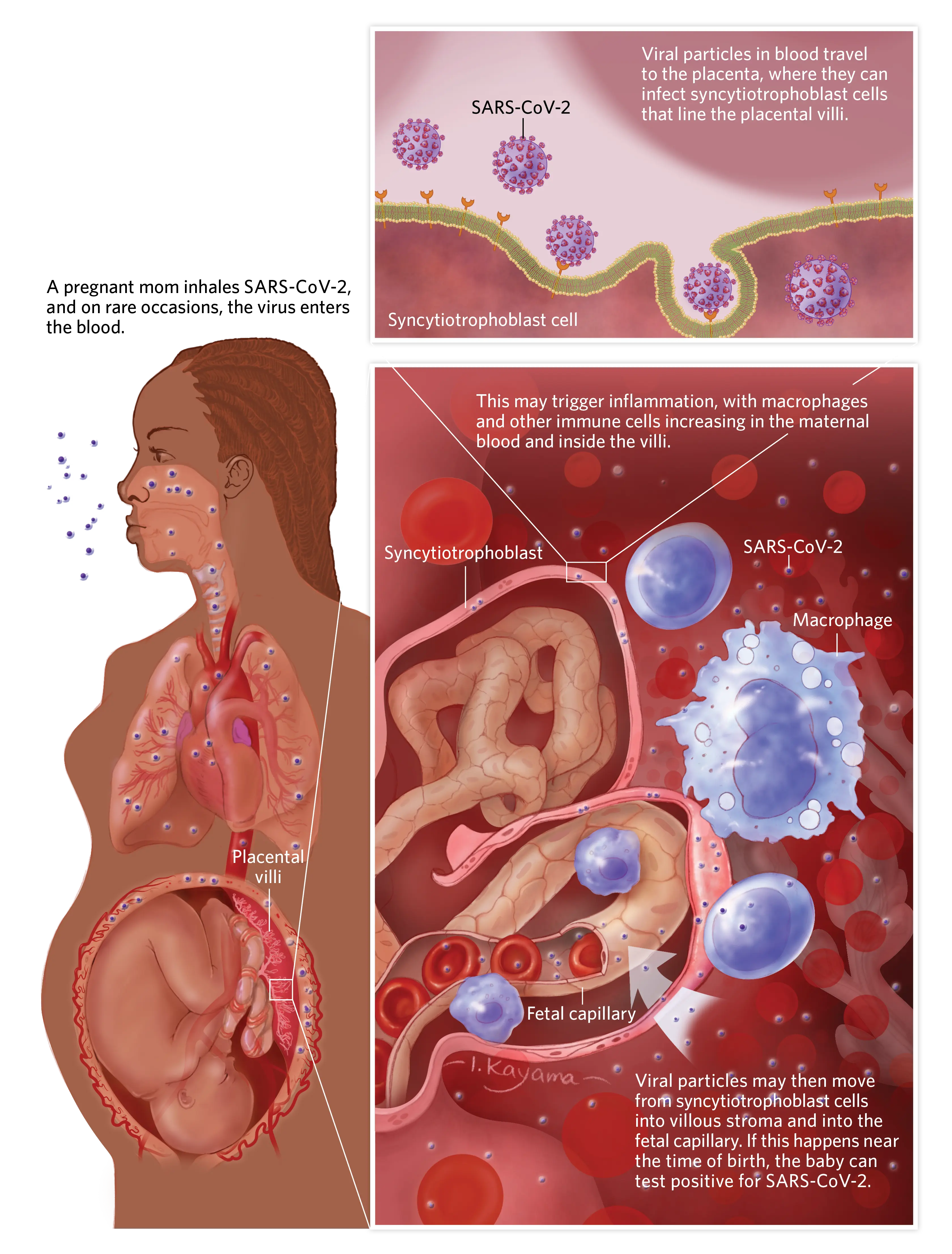 During her period, she coughed up blood. A second uterus was growing in her lungs