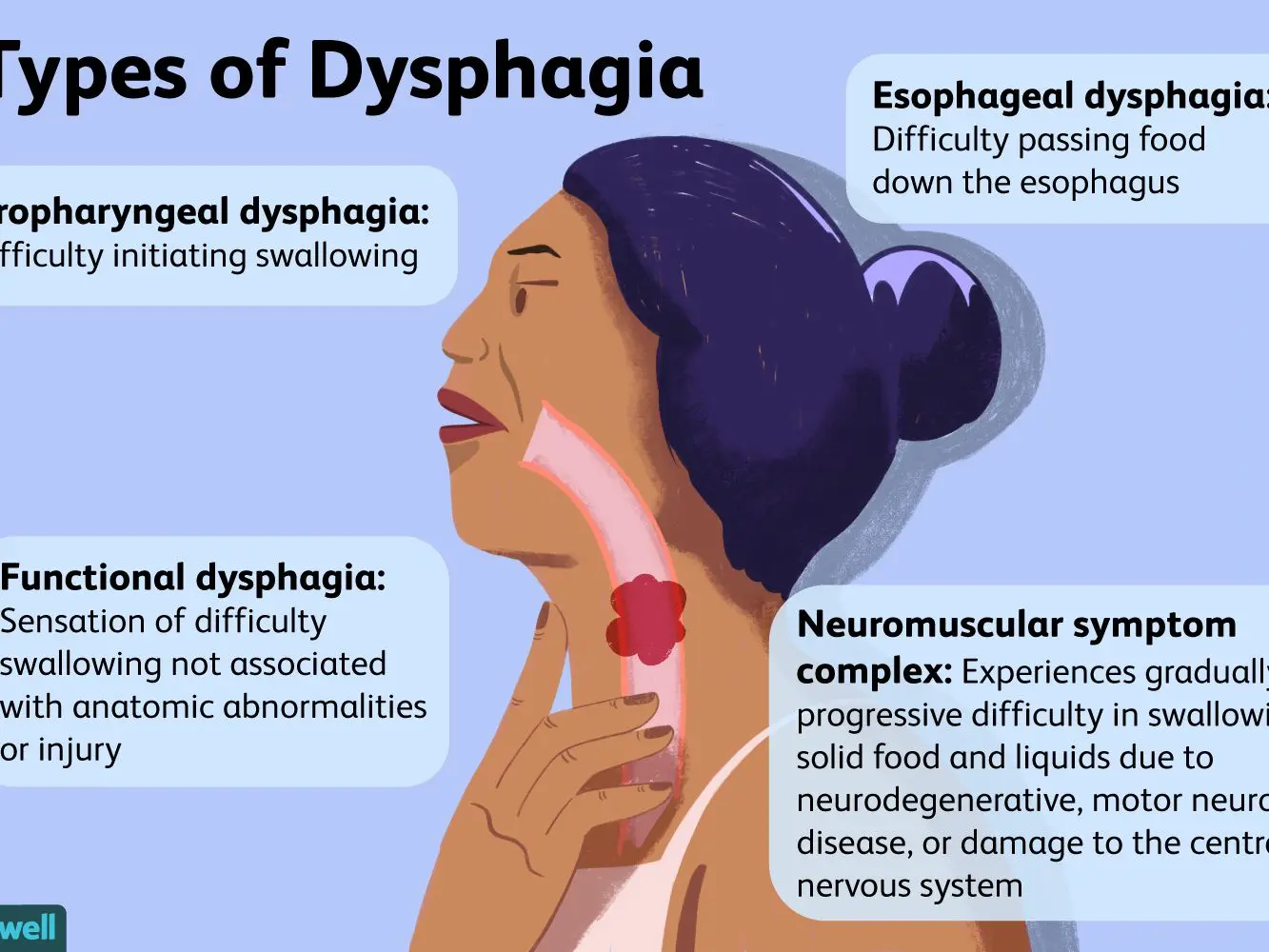 Dysphagia &#8211; causes, symptoms, diagnosis and treatment [EXPLAINED]