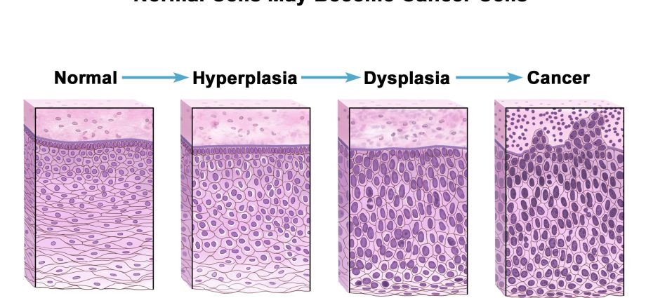 Dysplasia &#8211; degrees, types, characteristics