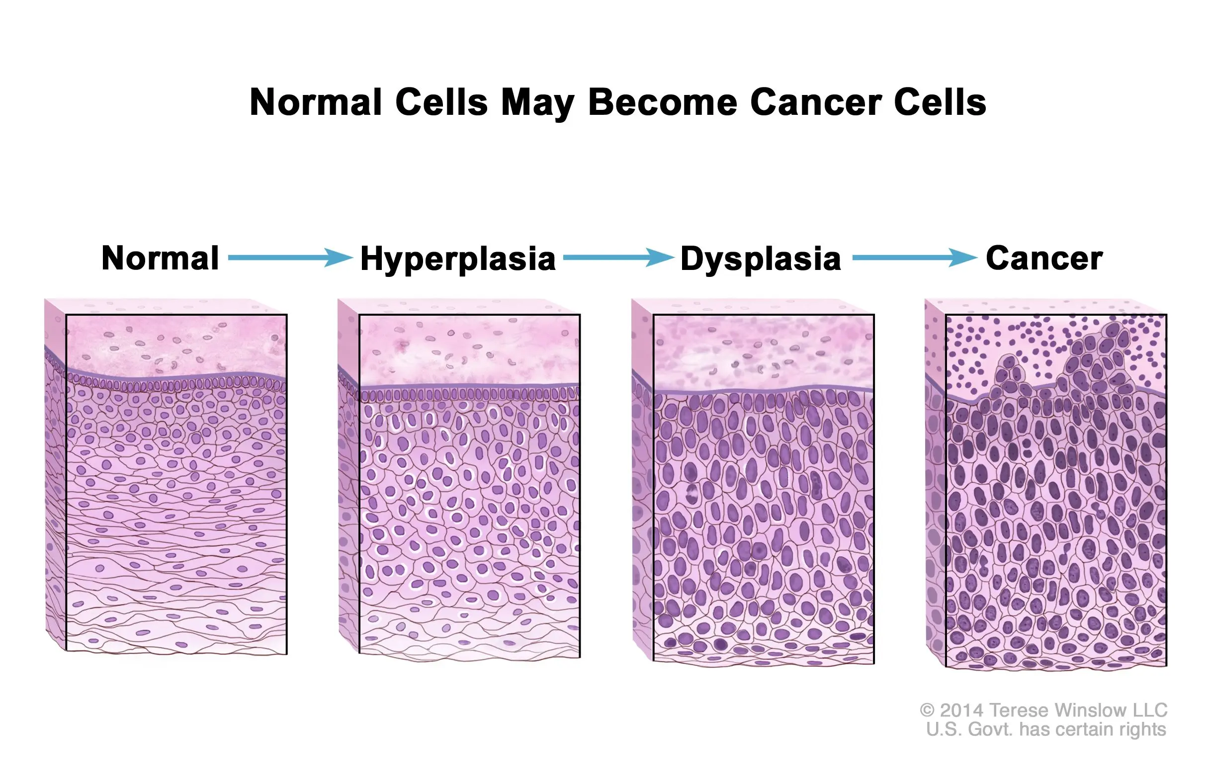 Dysplasia &#8211; degrees, types, characteristics