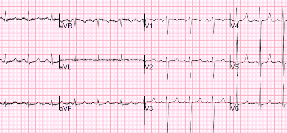 Dyspnea and EKG