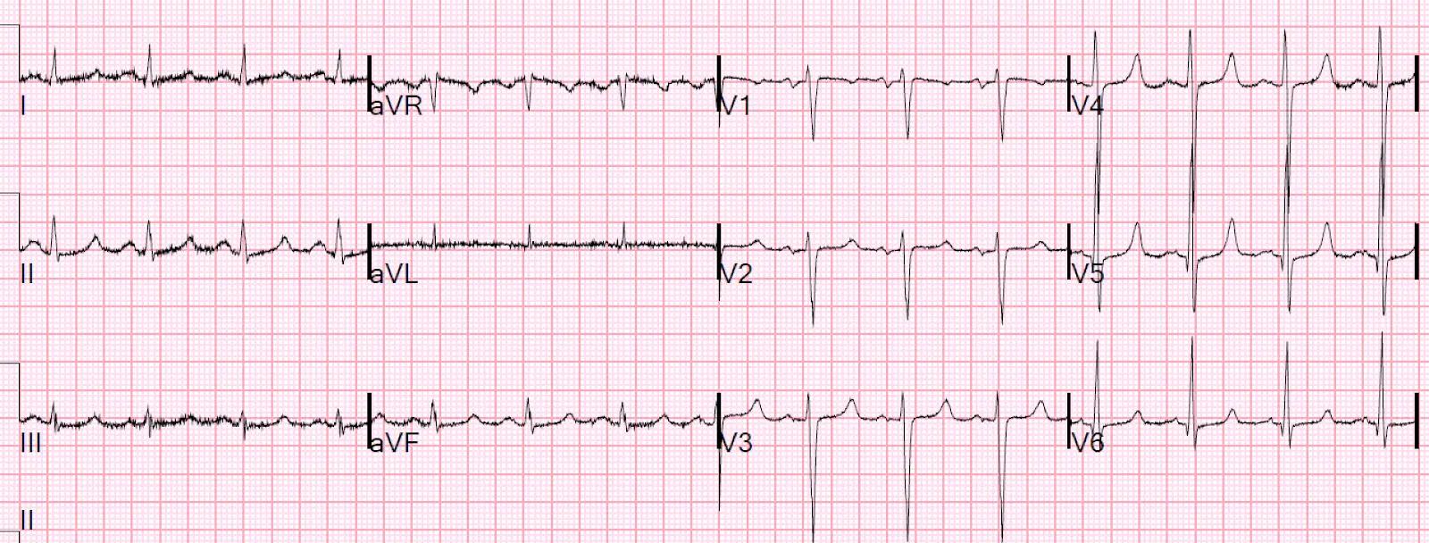 Dyspnea and EKG