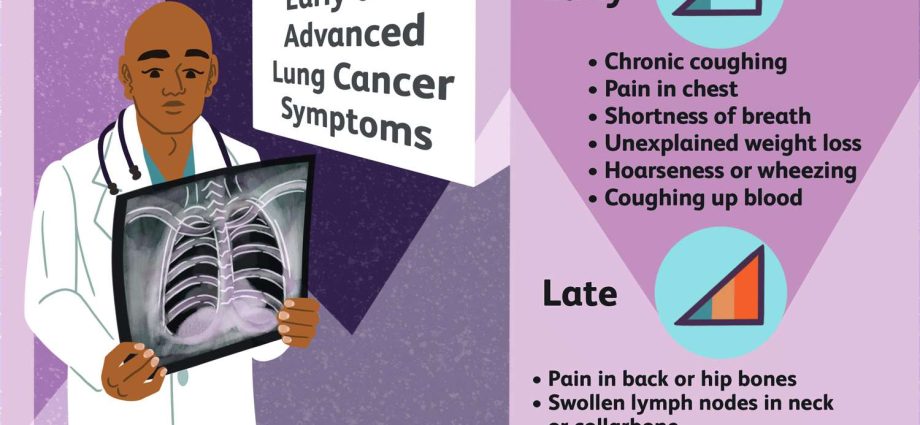 Early detection of lung cancer can save the patient&#8217;s life