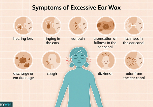 Earwax &#8211; when should it be removed?