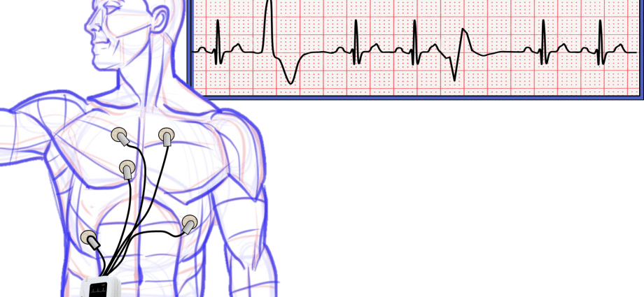 ECG recorder &#8211; indications, course, interpretation of results. How to prepare for a Holter EKG?