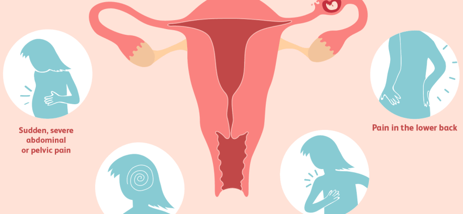 Ectopic pregnancy &#8211; symptoms, treatment. Ectopic pregnancy and subsequent pregnancy