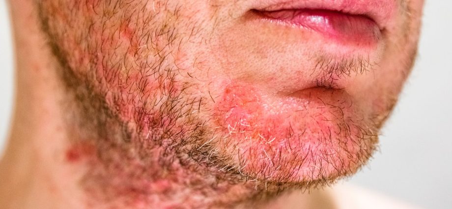 Eczema beard folliculitis