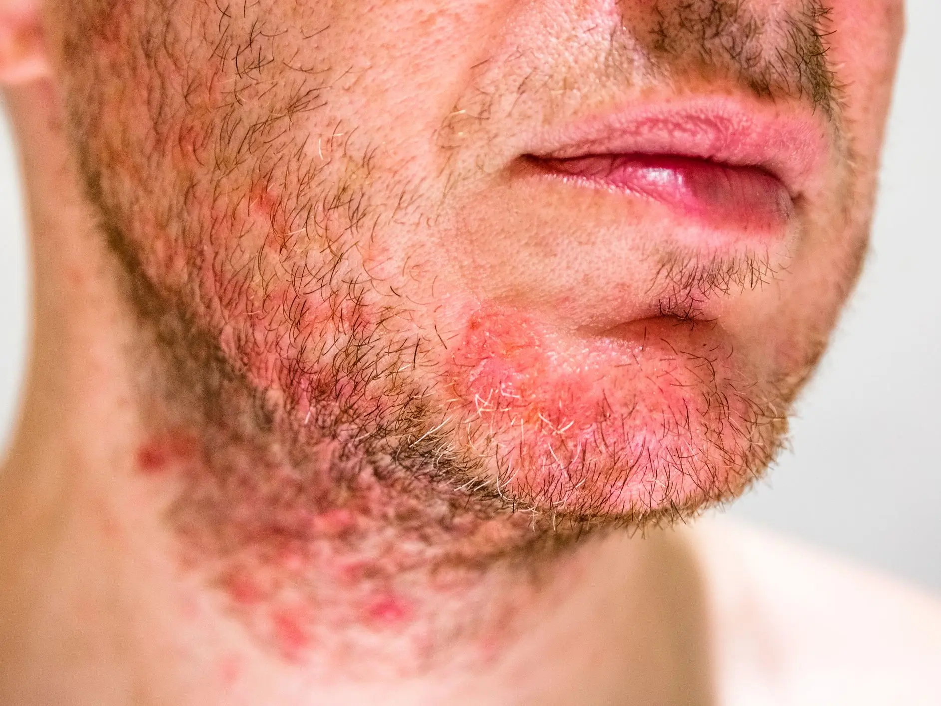 Eczema beard folliculitis