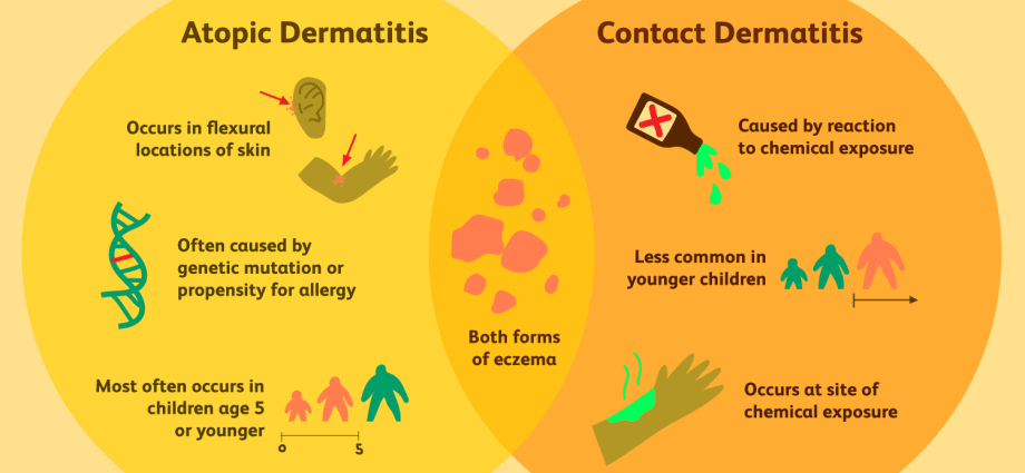 Eczema &#8211; causes, symptoms, treatment, diet. What is the difference between eczema and AD?
