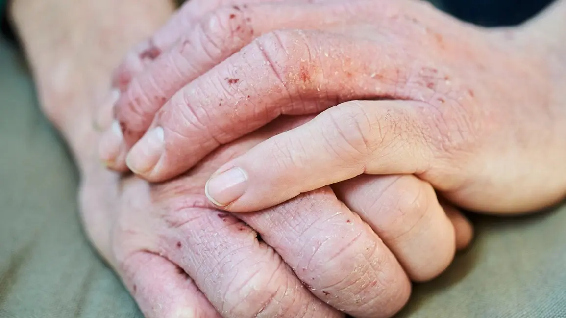 Eczema on the hands &#8211; causes, symptoms, treatment. How does the disease begin?