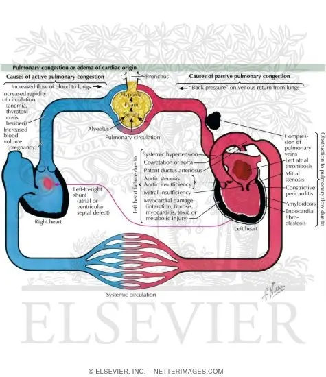 Edema of cardiac or congestive origin