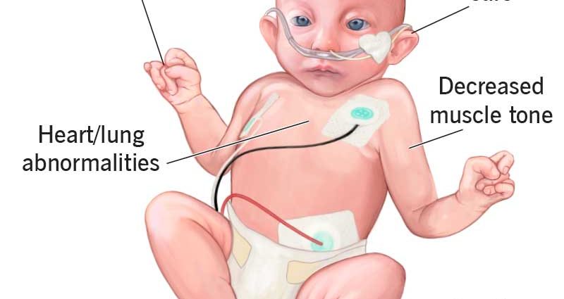 Edwards syndrome &#8211; causes, symptoms, treatment