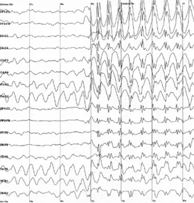 EEG (electroencephalography) &#8211; indications, course, interpretation of results. What is EEG?