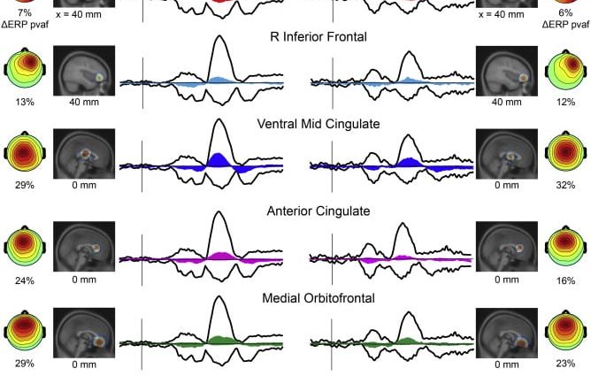 EEG testing can predict drug response in schizophrenia