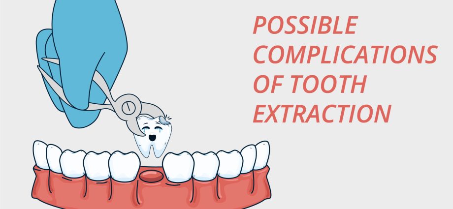 Eights extraction &#8211; preparations for the treatment. Possible complications after removing eights