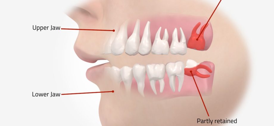 Eights &#8211; troublesome wisdom teeth