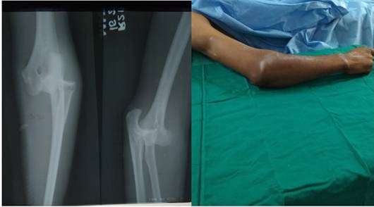 Elbow dislocation &#8211; what to do?