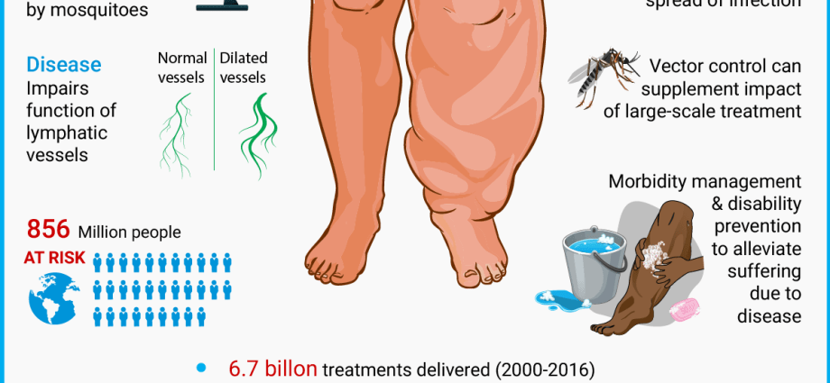 Elephantiasis &#8211; causes, symptoms, treatment