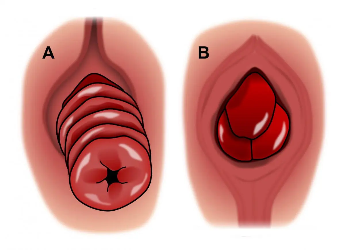 Embarrassing diseases of the anus