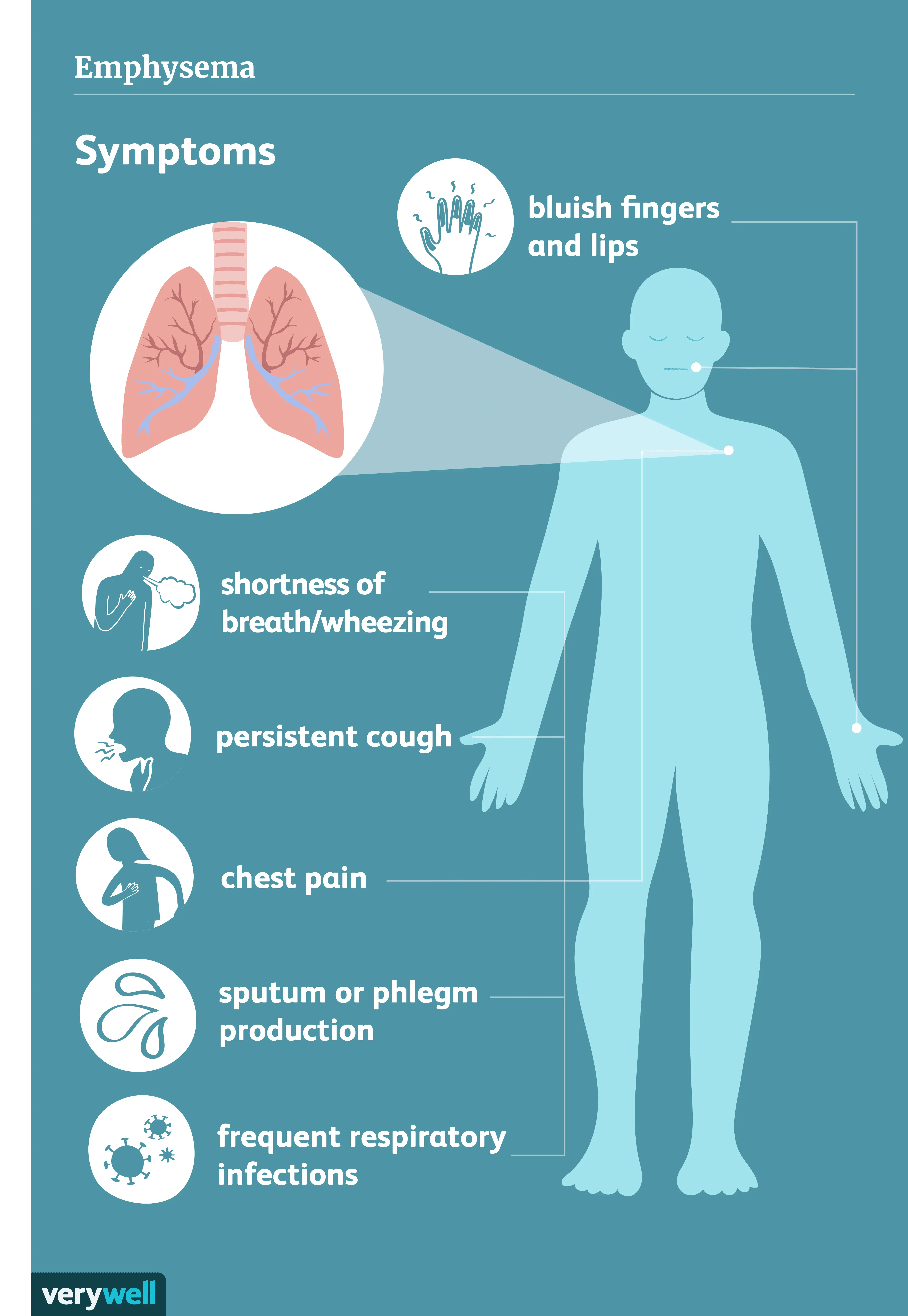 Emphysema of the lungs &#8211; what is it? Causes, symptoms, treatment