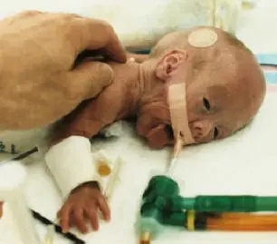 Endangered eyes of premature babies