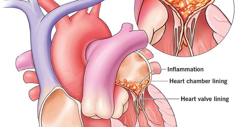 Endocarditis &#8211; causes of bacterial and rheumatic inflammation