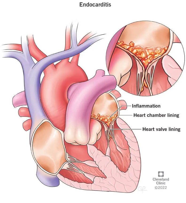 Endocarditis &#8211; causes of bacterial and rheumatic inflammation