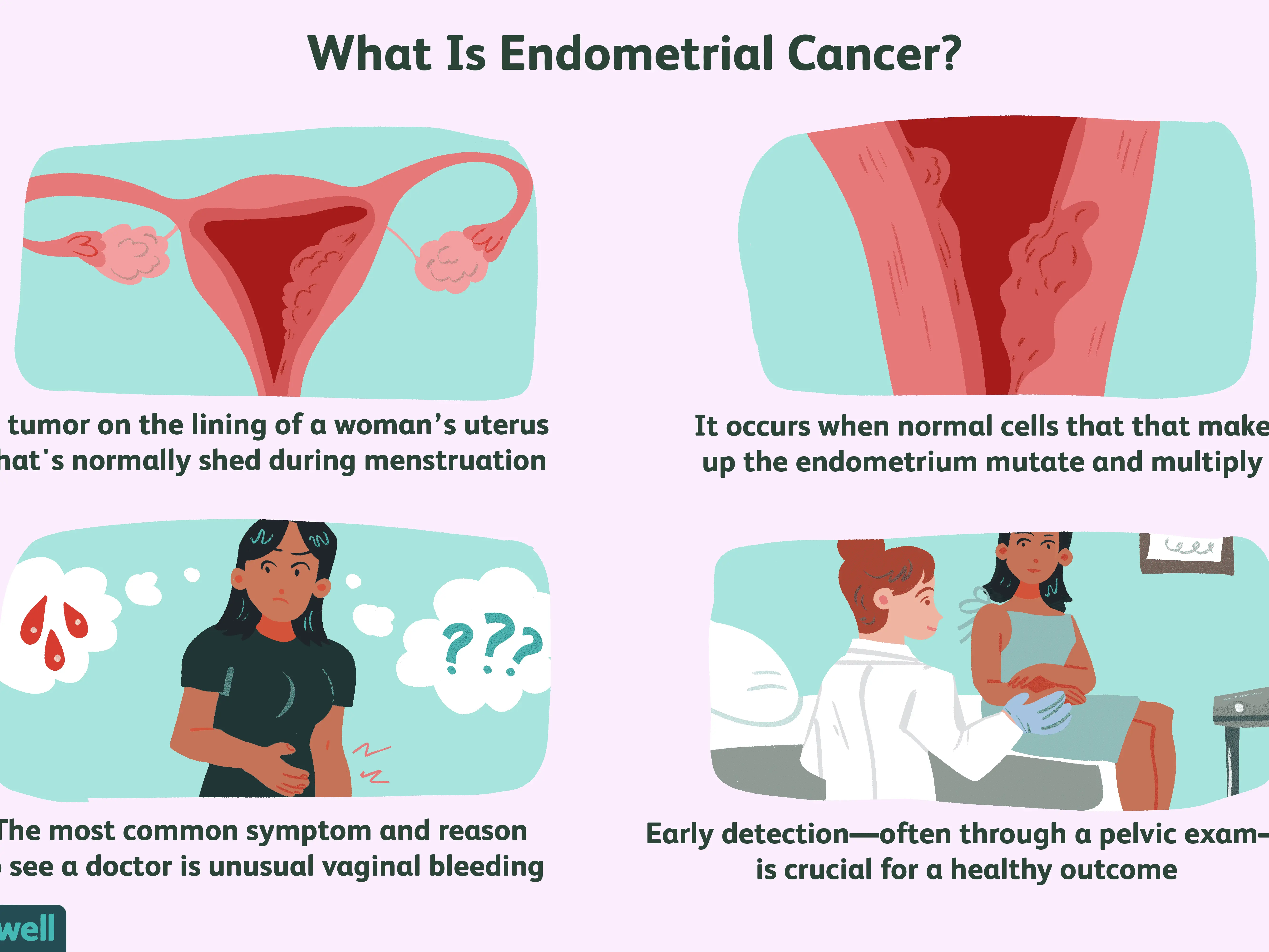 Endometrial cancer &#8211; symptoms, treatment. Endometrial cancer prevention