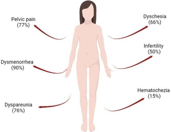 Endometriosis &#8211; an insidious disease that cannot be seen. It mainly affects young and thin women