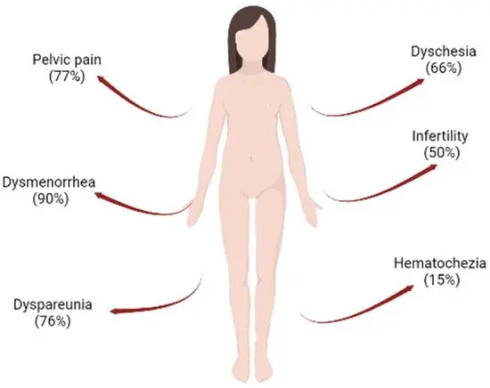 Endometriosis &#8211; an insidious disease that cannot be seen. It mainly affects young and thin women