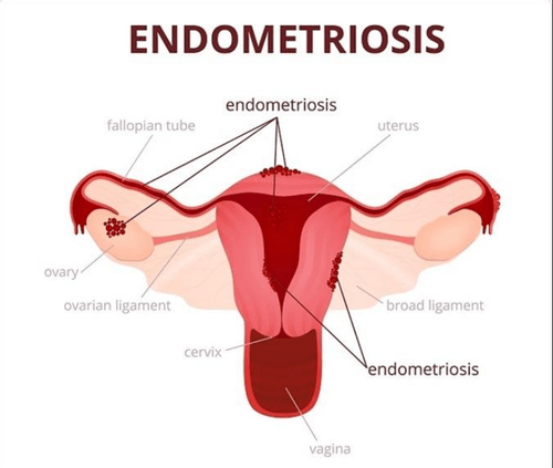 Endometriosis &#8211; causes, symptoms, treatment and consequences [WE EXPLAIN]