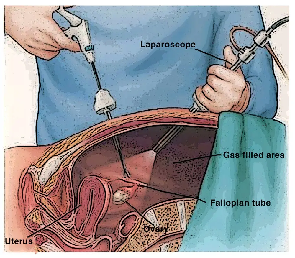 Endometriosis &#8211; surgical treatment