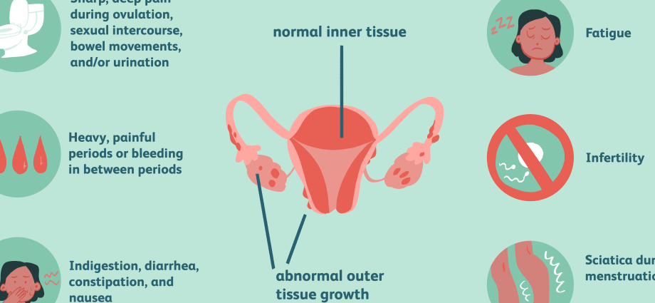 Endometriosis &#8211; symptoms, treatment, diet, causes [WE EXPLAIN]