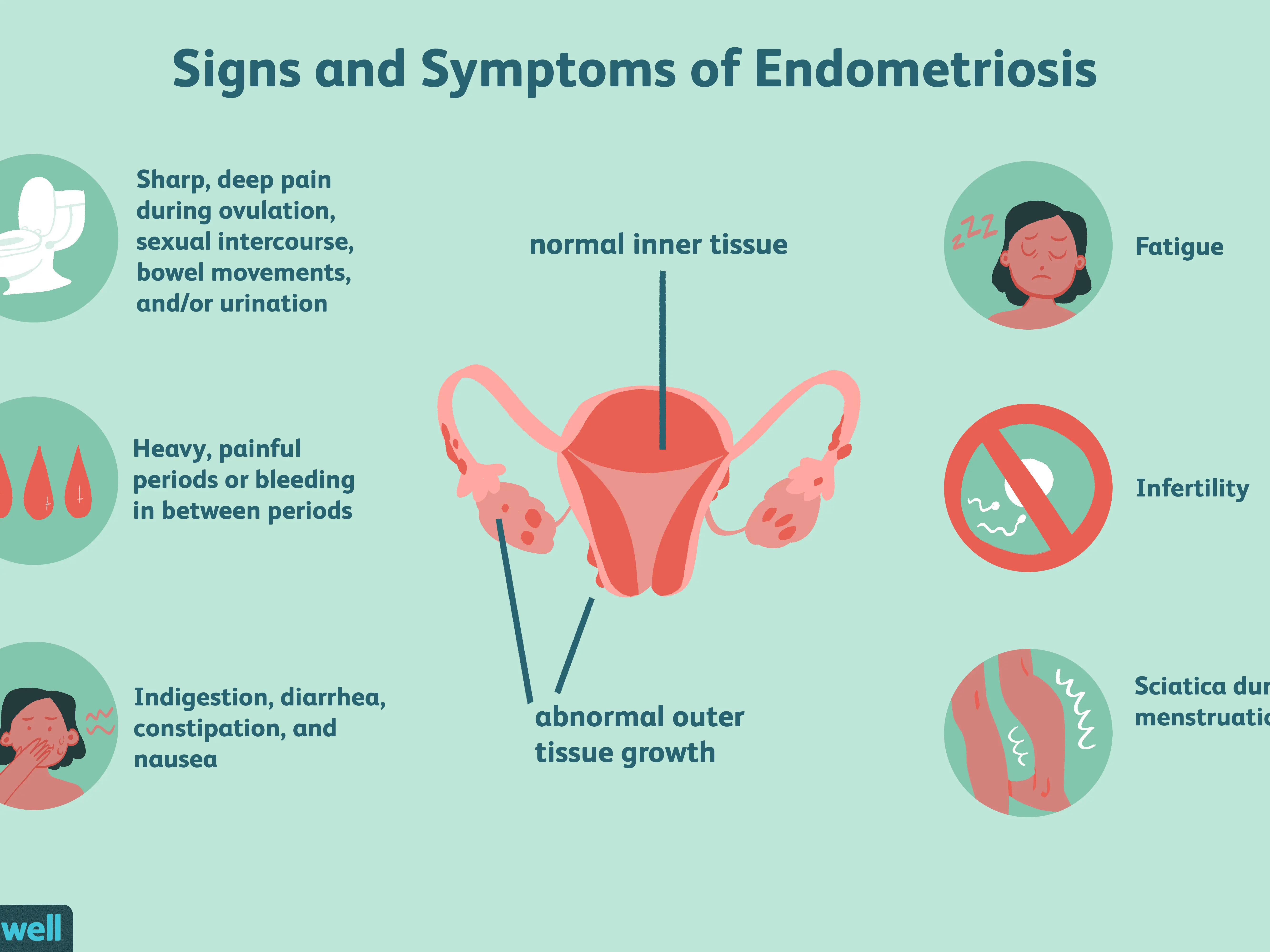 Endometriosis &#8211; symptoms, treatment, diet, causes [WE EXPLAIN]