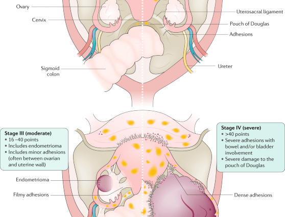 Endometriosis &#8211; wandering mucosa, causes, symptoms, disease detection